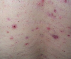 acne-dos-excoriee-1