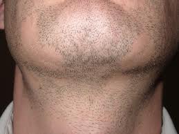 pelade barbe